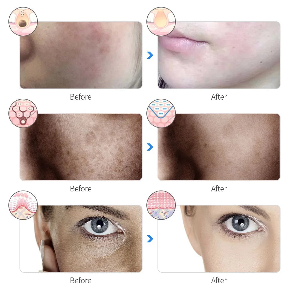 Photon Therapy LED Mask